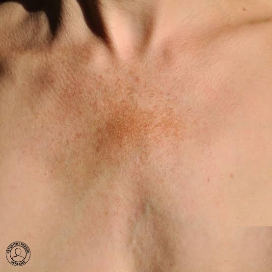 Fraksjonell laserbehandling av pigmentforandringer på hud