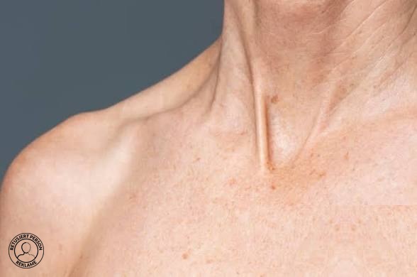 Solskader og pigmentforandringer på hals og nakke