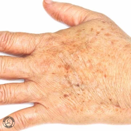 Solskader og pigmentforandringer på bryst og dekolletage